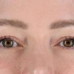 Eyelid Surgery Before & After Patient #1990