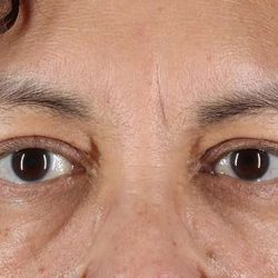 Eyelid Surgery Before & After Patient #2001
