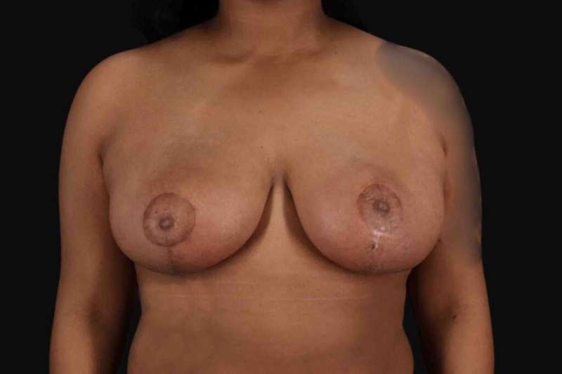 Breast Reduction with Lift Before & After Patient #905