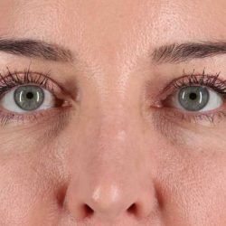 Eyelid Surgery Before & After Patient #2012
