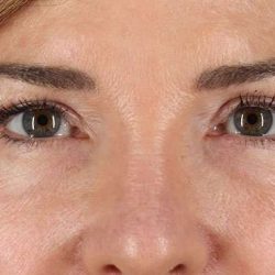 Eyelid Surgery Before & After Patient #2034