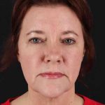 CO2 Laser Before & After Patient #2037