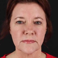 CO2 Laser Before & After Patient #2037