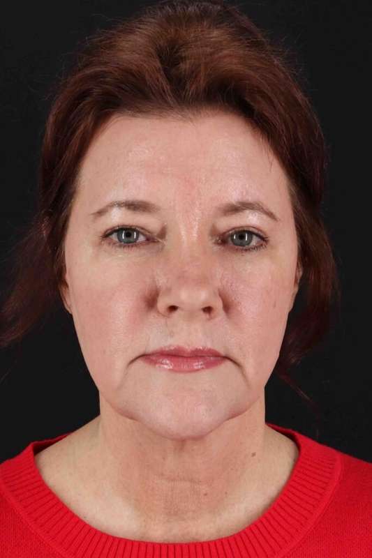 Laser Before & After Patient #2037