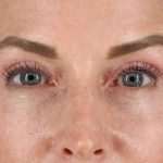 CO2 Laser Before & After Patient #2070