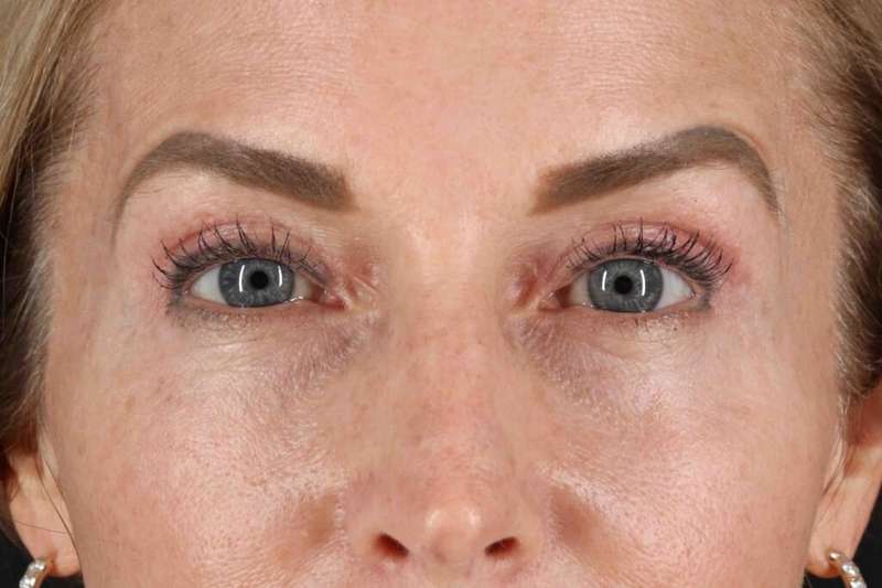 Laser Before & After Patient #2070