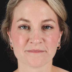 CO2 Laser Before & After Patient #2081