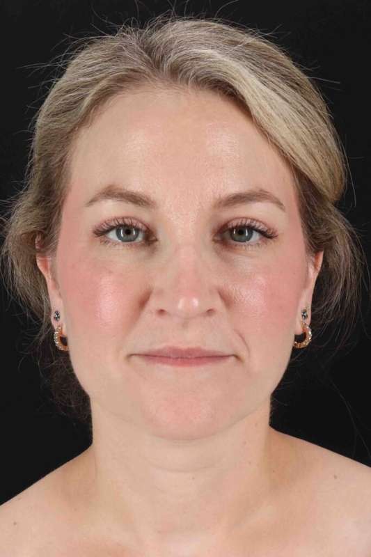 Laser Before & After Patient #2081