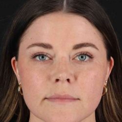 CO2 Laser Before & After Patient #2092