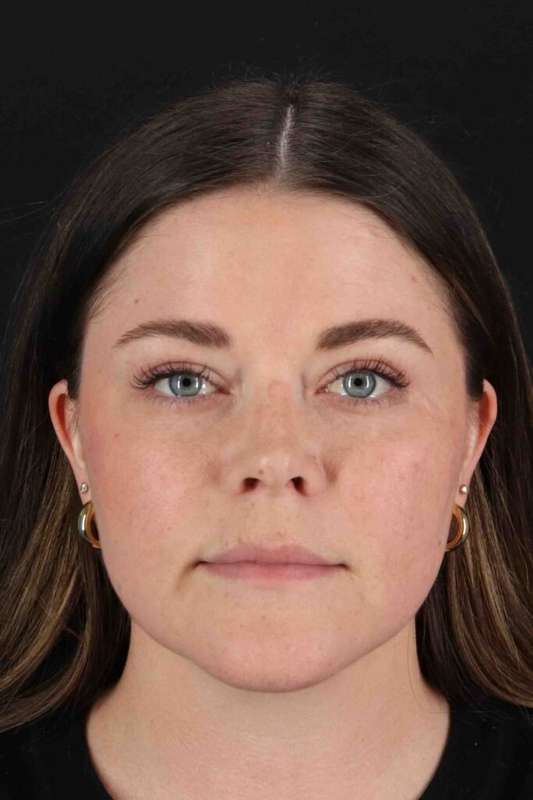 Laser Before & After Patient #2092