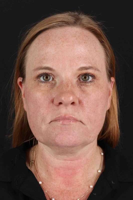 Laser Before & After Patient #2103