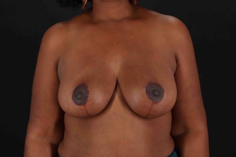 Breast Reduction with Lift Before & After Patient #917