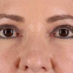 CO2 Laser Before & After Patient #2114
