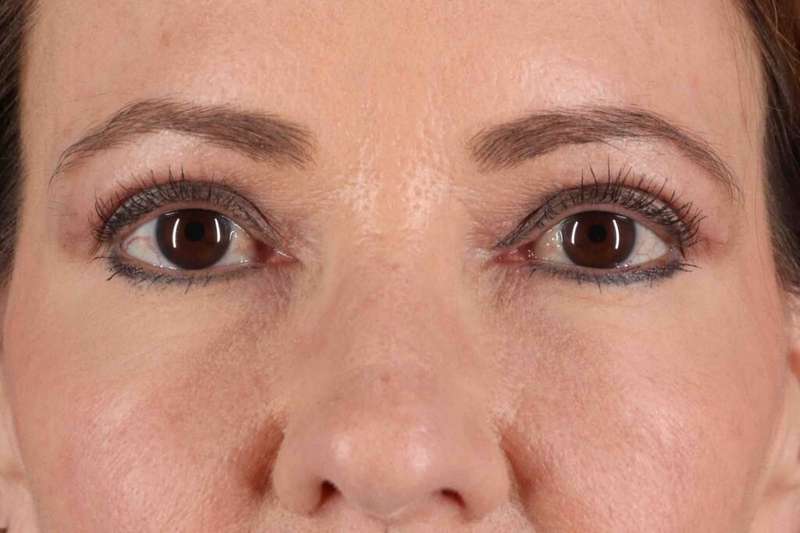 Laser Before & After Patient #2114