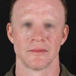 CO2 Laser Before & After Patient #2158