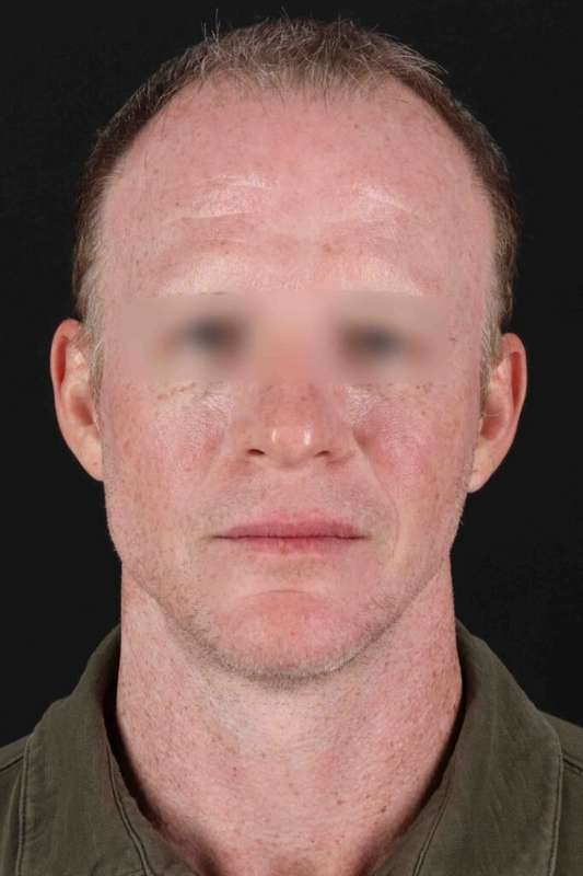Laser Before & After Patient #2158