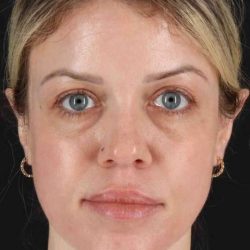 Chemical Peel Before & After Patient #2180