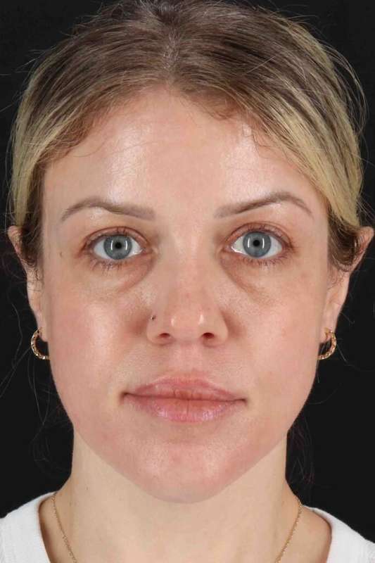 Chemical Peel Before & After Patient #2180