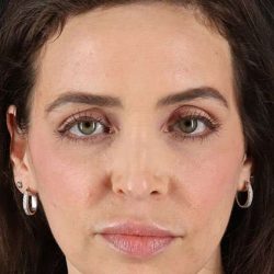 Chemical Peel Before & After Patient #2202
