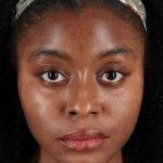 Chemical Peel Before & After Patient #2213