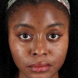 Chemical Peel Before & After Patient #2213