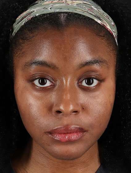 Chemical Peel Before & After Patient #2213