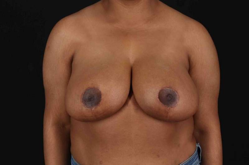 Breast Reduction with Lift Before & After Patient #928