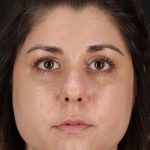 Chemical Peel Before & After Patient #2216