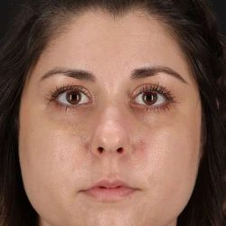 Chemical Peel Before & After Patient #2216