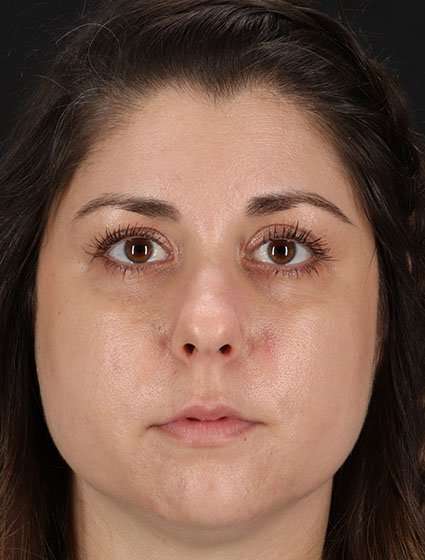 Chemical Peel Before & After Patient #2216