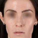 Cosmetic Injectables Before & After Patient #2236