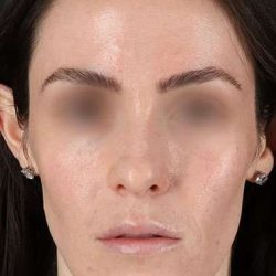 Cosmetic Injectables Before & After Patient #2236