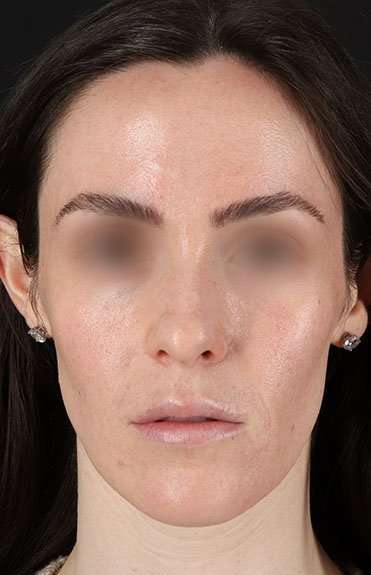 Cosmetic Injectables Before & After Patient #2236