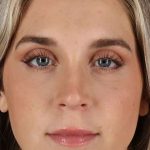 Cosmetic Injectables Before & After Patient #2239