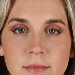 Cosmetic Injectables Before & After Patient #2239