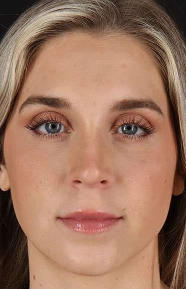Cosmetic Injectables Before & After Patient #2239