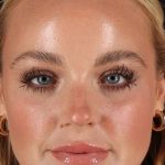 Cosmetic Injectables Before & After Patient #2242