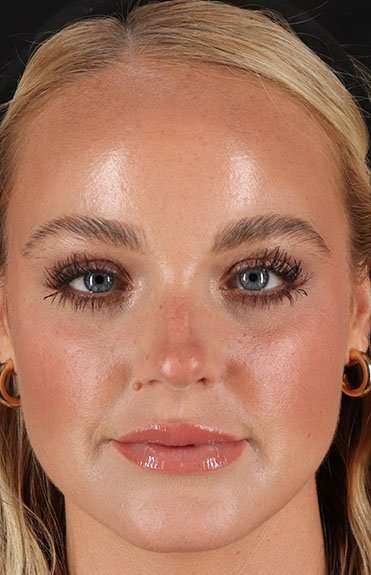 Cosmetic Injectables Before & After Patient #2242