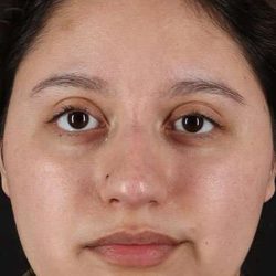 Cosmetic Injectables Before & After Patient #2253