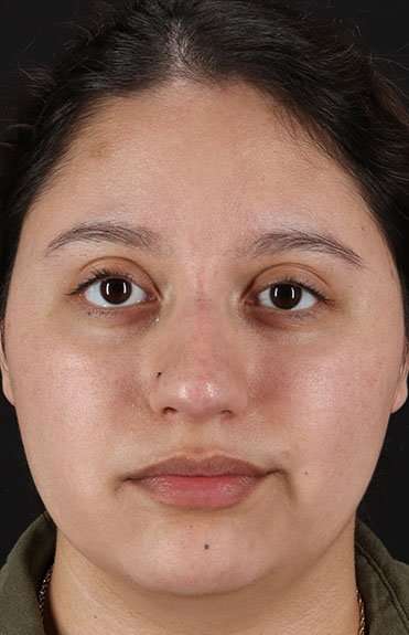 Cosmetic Injectables Before & After Patient #2253