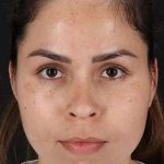 Cosmetic Injectables Before & After Patient #2264