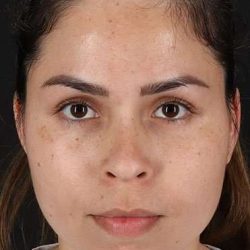 Cosmetic Injectables Before & After Patient #2264