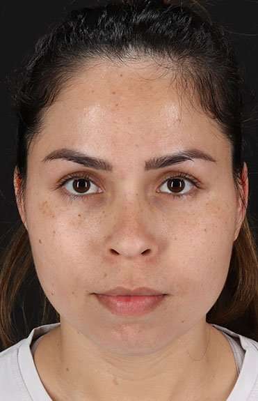 Cosmetic Injectables Before & After Patient #2264