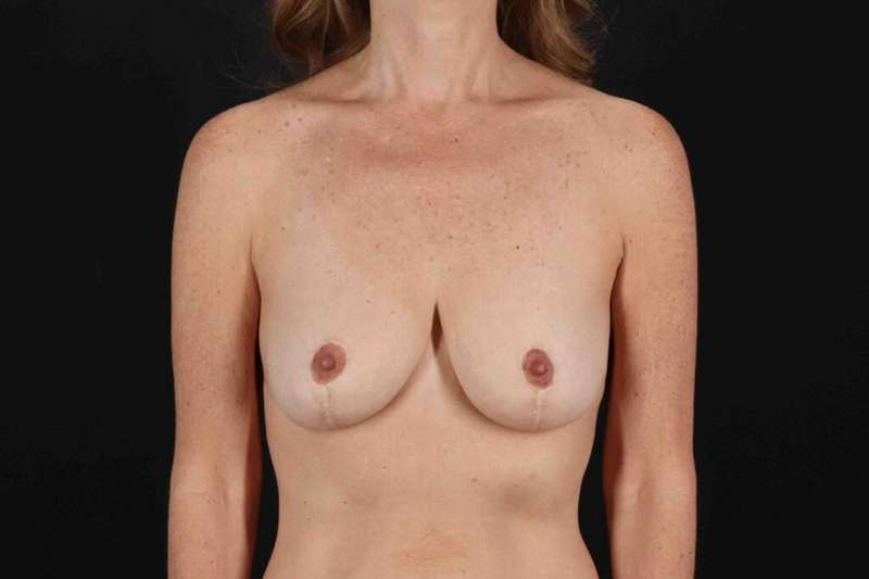 Breast Reduction with Lift Before & After Patient #939