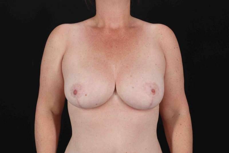 Breast Reduction with Lift Before & After Patient #950