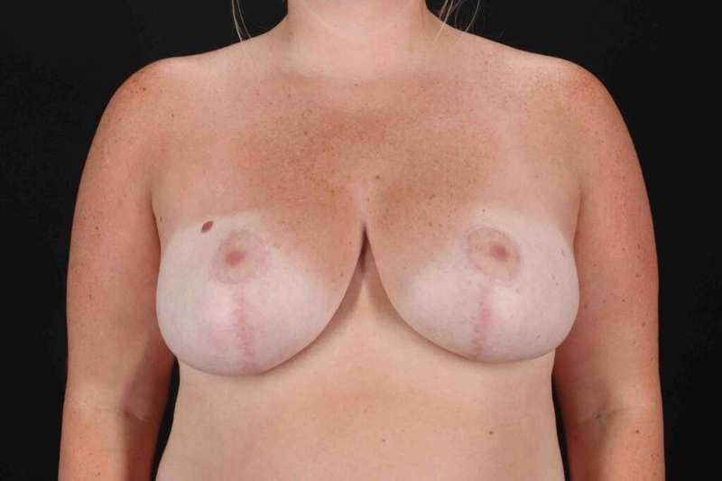 Breast Reduction with Lift Before & After Patient #961
