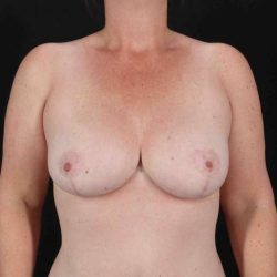 Breast Reduction with Lift Before & After Patient #972