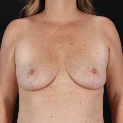 Breast Reduction with Lift Before & After Patient #983