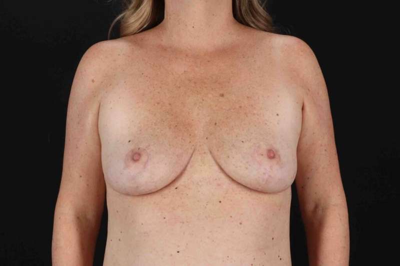 Breast Reduction with Lift Before & After Patient #983