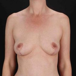 Breast Augmentation with Fat Transfer Before & After Patient #806